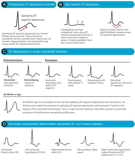 ECG interpretation: Characteristics of the normal ECG (P-wave, QRS ...