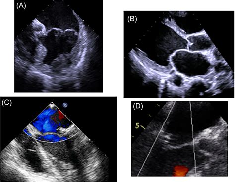 Transesophageal echocardiography. Preoperative: (A) bileaflet prolapse ...