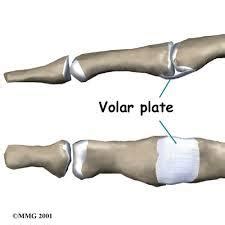 Volar Plate Avulsion Injury Treatment in Ahmedabad | ID: 7748836091