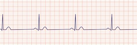 Bradycardia Definition, Causes, Symptoms & Treatment - Phlebotomy ...