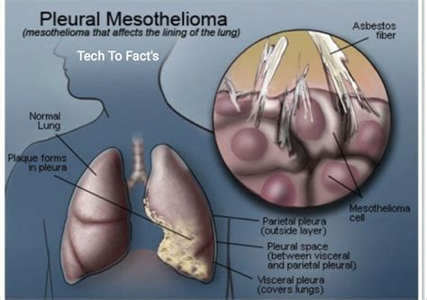 What is Pleural Mesothelioma?