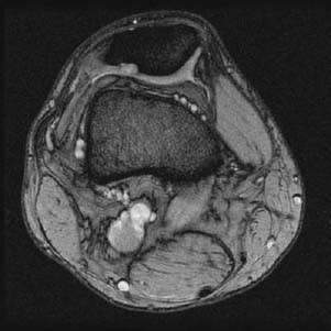 12 Chondromalacia Patellae | Radiology Key