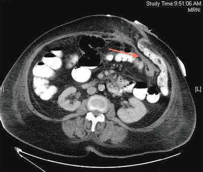 Laparoscopic Stoma Reversal | Abdominal Key