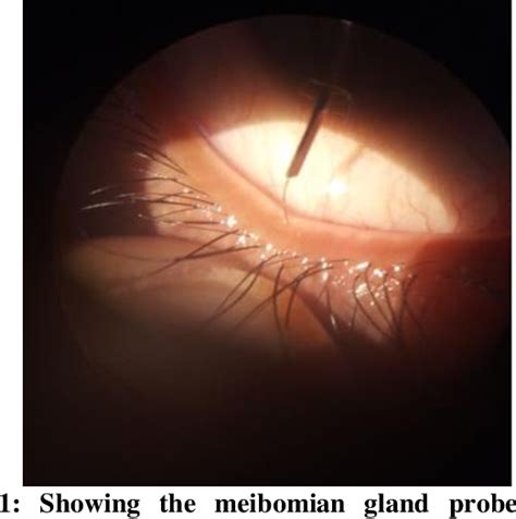 Figure 1 from Meibomian gland probing in patients with meibomian gland ...