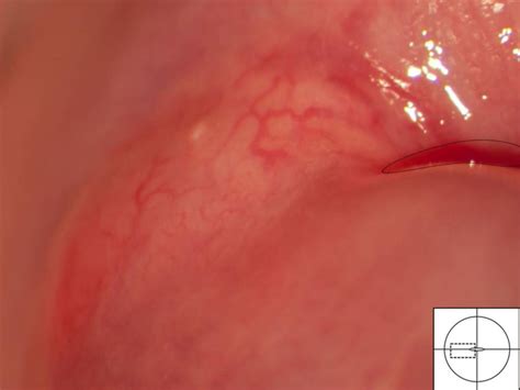 Nabothian cyst in cervix causes, symptoms & nabothian cyst treatment