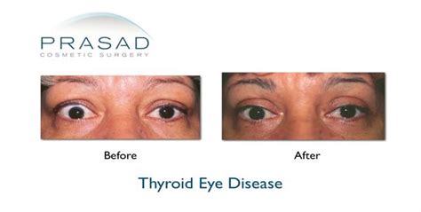 Thyroid Eye Disease- Graves Disease | Prasad Cosmetic Surgery | NY