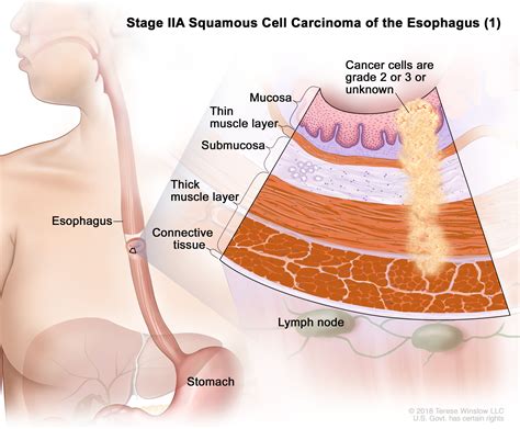 Esophageal Cancer Treatment (PDQ®) - NCI