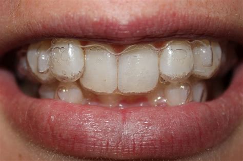 The Road to Straight Teeth: Aligner #3: Attachments