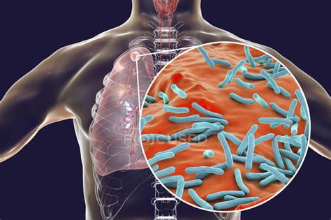 Secondary tuberculosis lungs infection and close-up of Mycobacterium ...