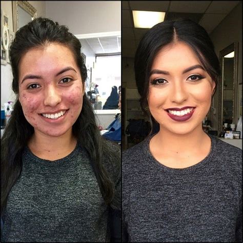 18 Insane Acne Transformations That Prove The Power Of Makeup (Có hình ...