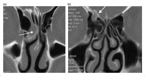 (a) CT Sinus scan: anomalous 'flask-shaped' anterior ethmoid air cell ...