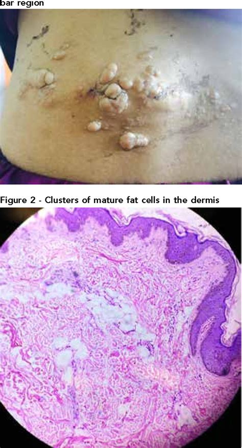 Naevus Lipomatosus Cutaneous Superficialis of Hoffman and Zurhelle- A ...