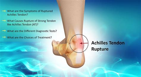 Pin on Achilles Tendonitis