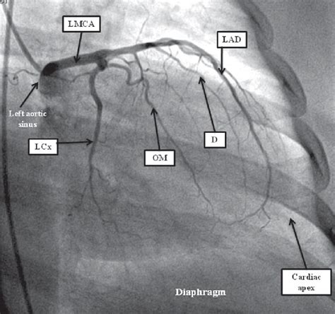 Coronary Angiogram : All You Need To Know - CVSKL