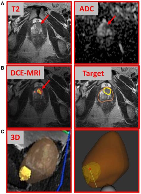 Frontiers | Multiparametric-MRI and Targeted Biopsies in the Management ...