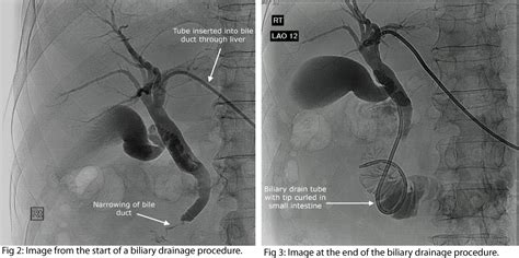 Biliary Drainage - InsideRadiology