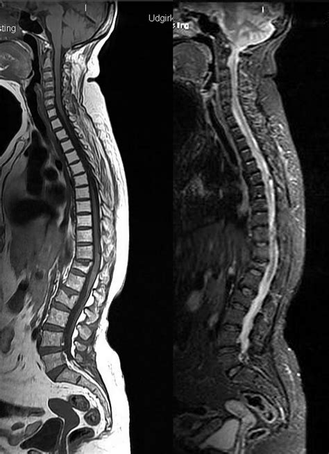 The Spinal Cord: Mri Of The Spinal Cord