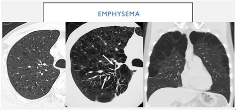 Differential diagnosis of cystic lung are many and inconsistent ...