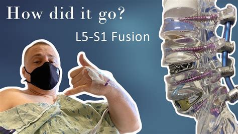 L5-S1 Fusion - Back Surgery - Back Fusion - YouTube