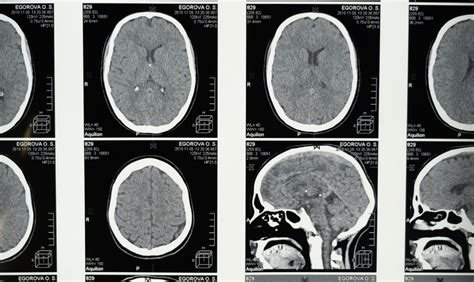 Frontal Lobe Damage | 1-800-Injured