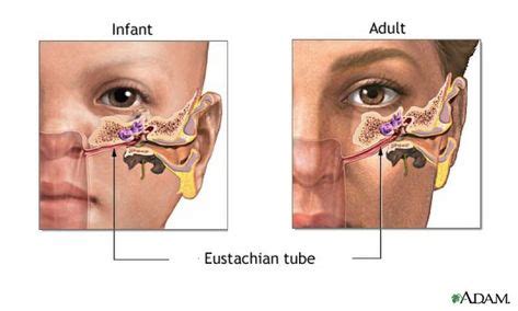 The Eustachian Tube - ENT Clinic (With images) | Ear infection remedy ...