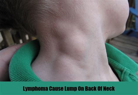 Causes & Symptoms Of Lump On Back Of Neck – Natural Home Remedies ...