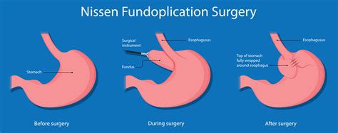 Types Of Hiatal Hernia Surgery