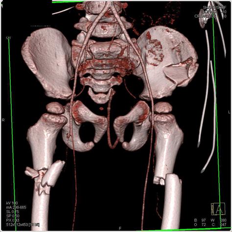 Bilateral Femur Fractures Following an MVA - Musculoskeletal Case ...