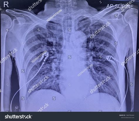 Perihilar Infiltration Both Lungs ภาพสต็อก 1360700444 | Shutterstock