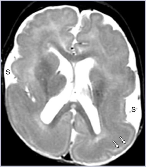 Lissencephaly Radiology