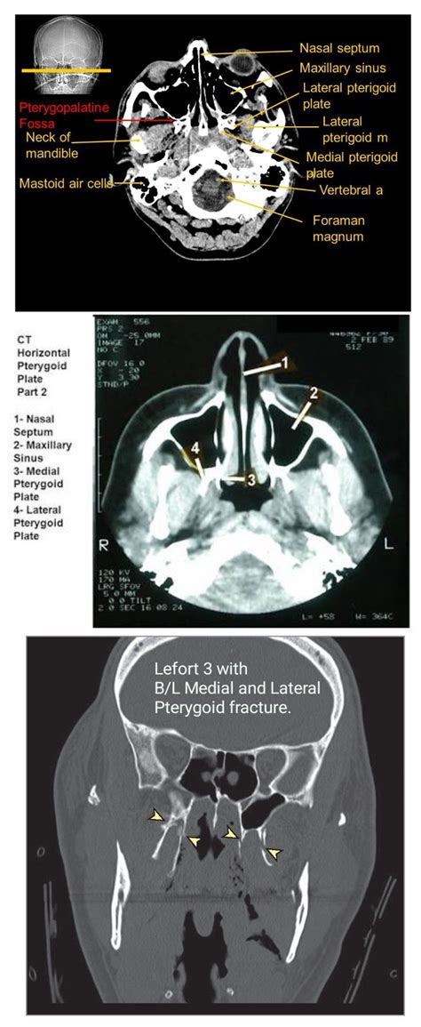 Medial and Lateral pterygoid on CT | Brain anatomy, Ct scan, Head anatomy