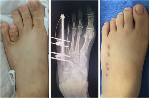 Treatment of Fourth Metatarsal Brachymetatarsia Using Distraction ...