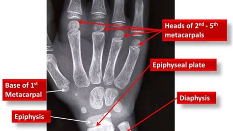 X Ray Bone Age Chart