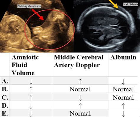 NeoQuest August 2023: Fetal Complications in a Monochorionic Diamniotic ...