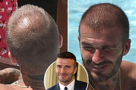 David Beckham | Hair loss Forum - Hair Transplant forums