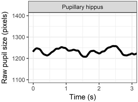 Pupillary hippus, or small ongoing fluctuations in pupil size that are ...