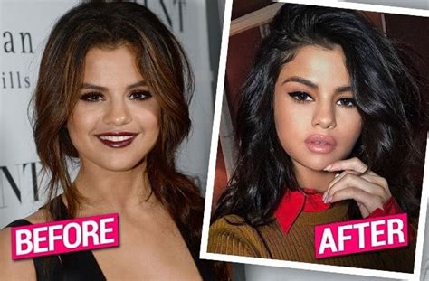 5 Celebrities Who Had Lip Augmentation