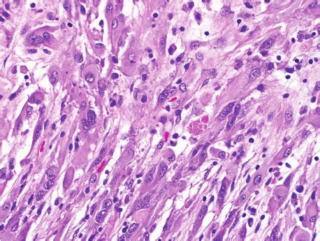 A: Pleomorphic xanthoastrocytoma (WHO grade II). Pleomorphic ...