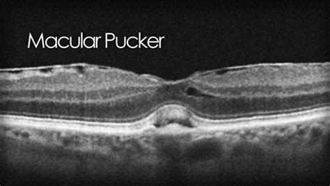 What is macular pucker? A guide to causes and treatments