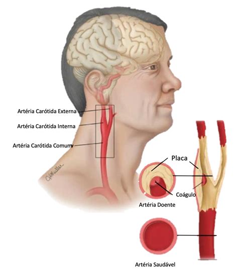 Doença Carotídea ou Estenose da Artéria Carótida