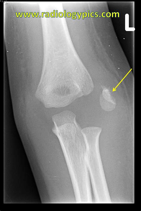 Lateral Epicondyle Avulsion Fracture – RADIOLOGYPICS.COM