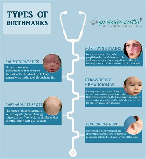 Types of Birthmarks | Birthmark, Laser clinics, Port wine stain