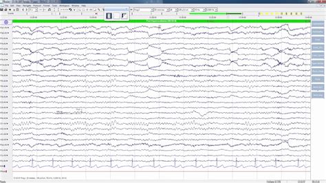 Normal Eeg Report Sample - mapasgmaes