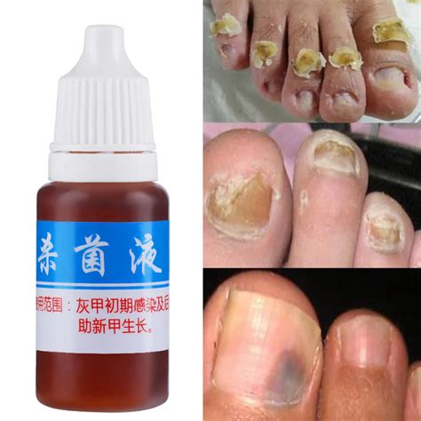 10ml Nail Fungus Treatment Cream Onychomycosis Paronychia Anti Fungal ...