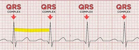 Análisis del Ritmo Cardíaco - Cerebromedico