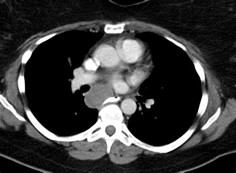 Duplication Cyst Mediastinum - Chest Case Studies - CTisus CT Scanning