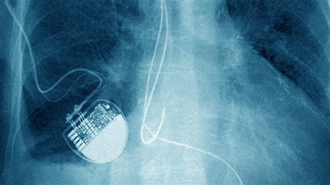 The FDA Guidelines to Block Attempts to Hack Your Pacemaker