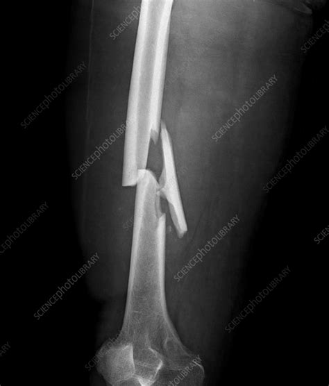 Comminuted femur fracture, X-ray - Stock Image - F035/8734 - Science ...