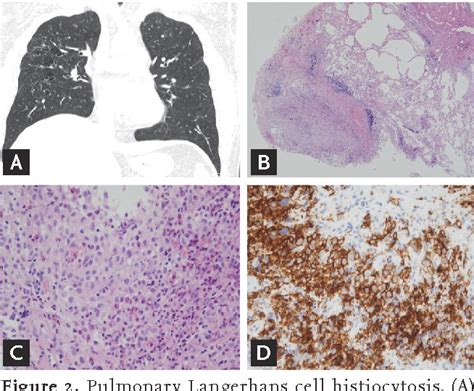 Figure 2 from Diagnosis and treatment of cystic lung disease | Semantic ...