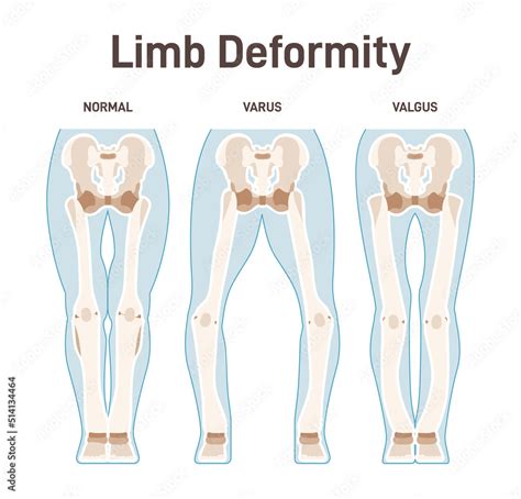 Vetor de Limb anatomy scheme. Valgus and varus leg deformities. Diagram ...